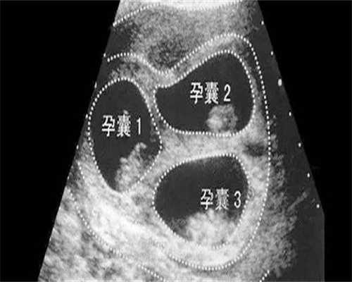 试管婴儿三代是不是最好